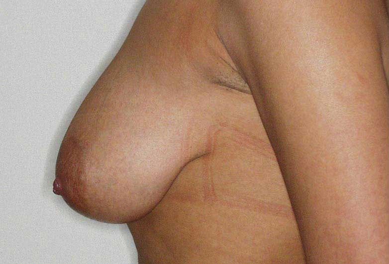 Levantamiento-de-Senos-antes