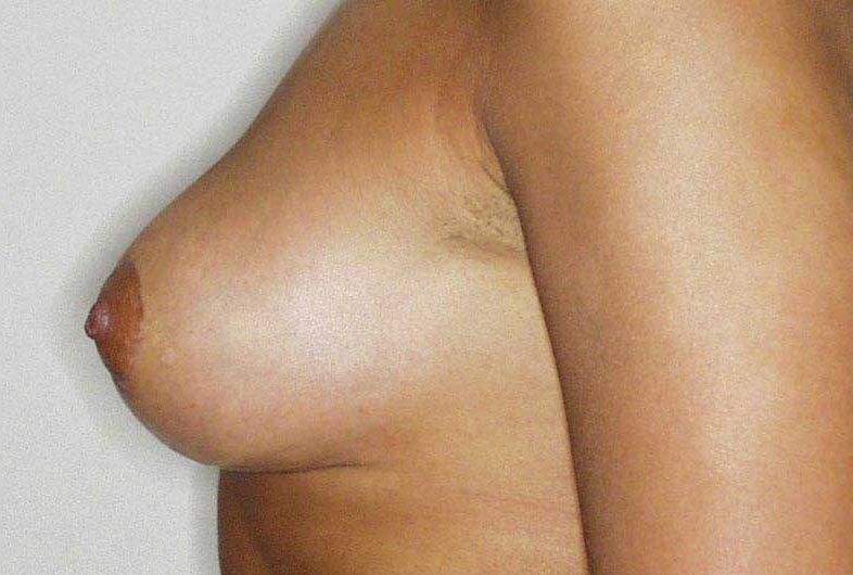 Levantamiento de senos después, Dr Jean Carlos Angulo