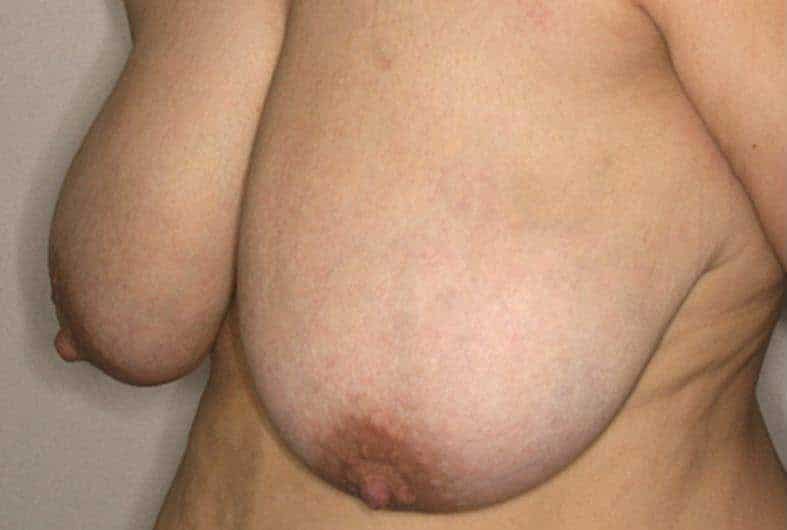 Mamoplastia de Reduccion Dr Angulo Cirujano Plastico