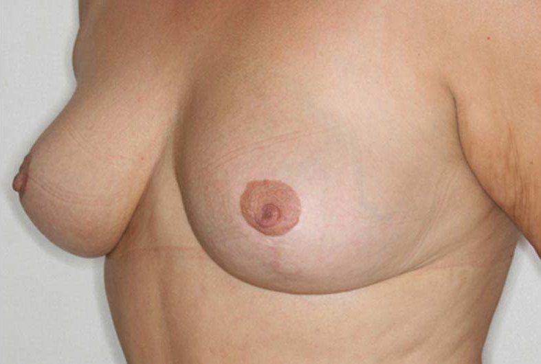 Mamoplastia de Reduccion Dr Angulo Cirujano Plastico