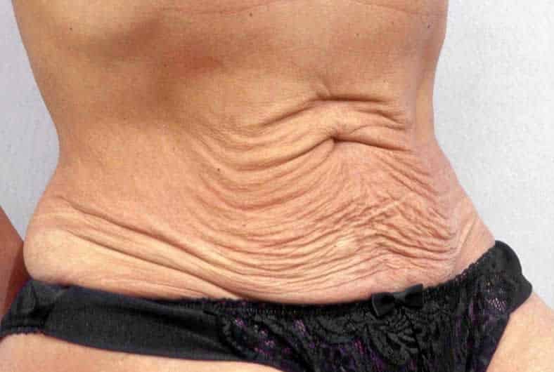 Abdominoplastia antes, Dr Jean Carlos Angulo