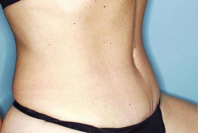 Abdominoplastia después, Dr Jean Carlos Angulo