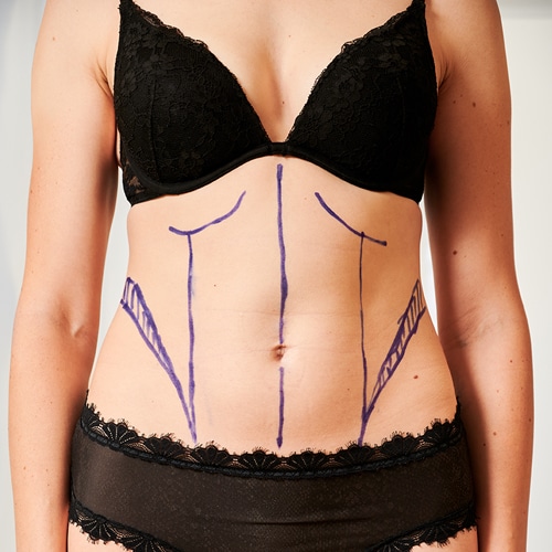 Cirugia corporal Dr Jean Carlos Angulo